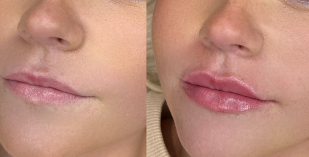 Before and after lip filler: subtle, natural-looking enhancement of lip shape